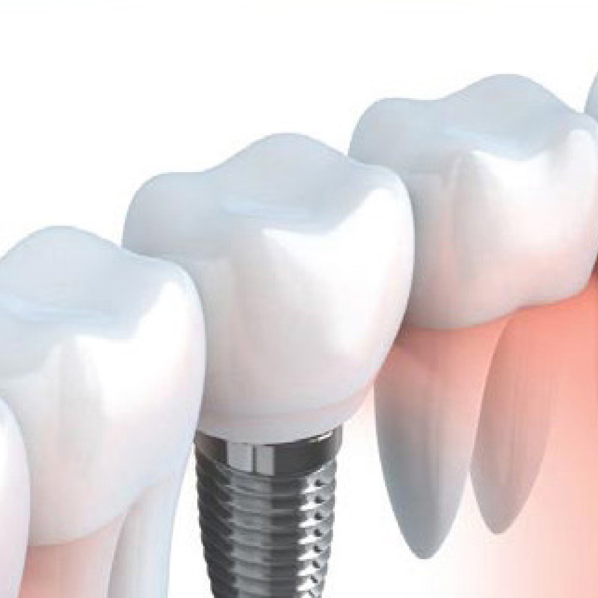 Dental Practice/ENDODONTICS/Endodontic Posts